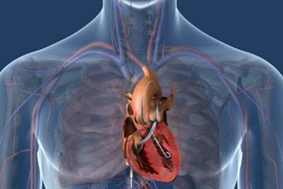 Impella im Körper_abiomed